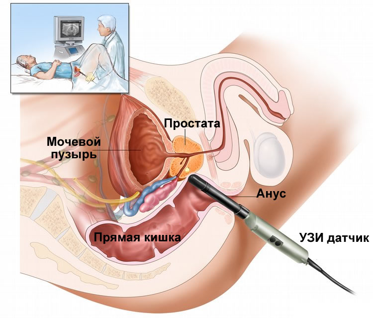 Ultrasound diagnosis of prostate