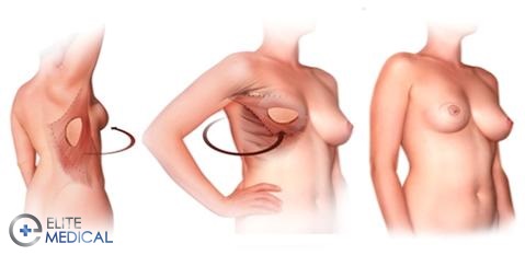 Breast reconstruction after mastectomy operation